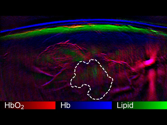 Breast cancer - Kukačka et al.